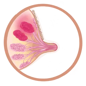Explicación de qué es la mastitis