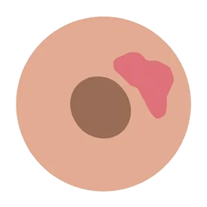 síntoma de la mastitis con lactancia