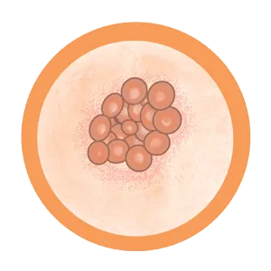 Estafilococo Epidermis provoca la mastitis subaguda