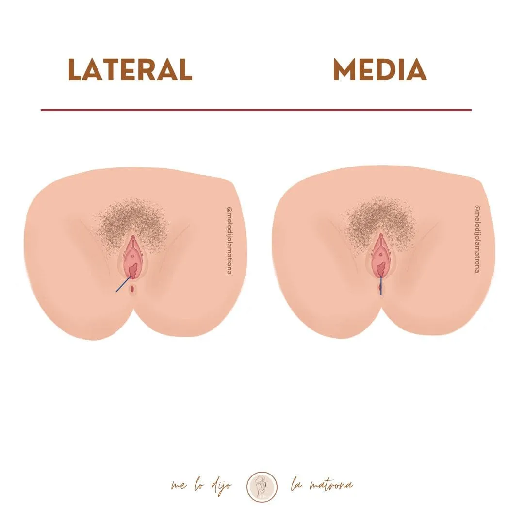 episiotomia lateral y media