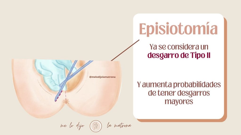 episiotomia definicion corte