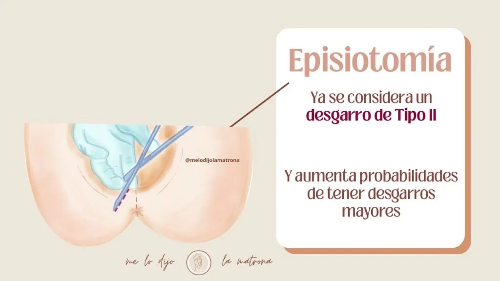 episiotomia definicion corte