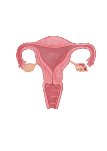 es normal no tener sintomas embarazo utero