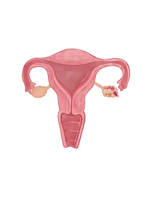 es normal no tener sintomas embarazo utero
