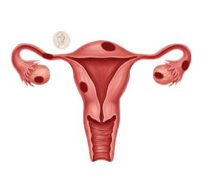 cómo se detecta la endometriosis sistema reproductor femenino, lesiones de endometriosis en el útero, trompas de falopio, ovários