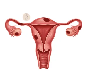 cómo se detecta la endometriosis sistema reproductor femenino, lesiones de endometriosis en el útero, trompas de falopio, ovários 