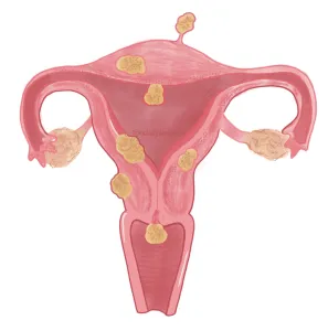 cómo se detecta la endometriosis aparato reproductor femenino, focos de endometriosis en útero, ovarios, trompas de falopio