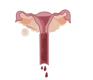 cómo se detecta-la endometriosis, aparato reproductor femenino, útero, ovarios, trompas de falopio, gotas de sangre