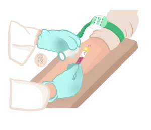 cómo se detecta la endometriosis extracción de sangre en brazo de una persona utilizando un tubo de ensayo para análisis clínicos