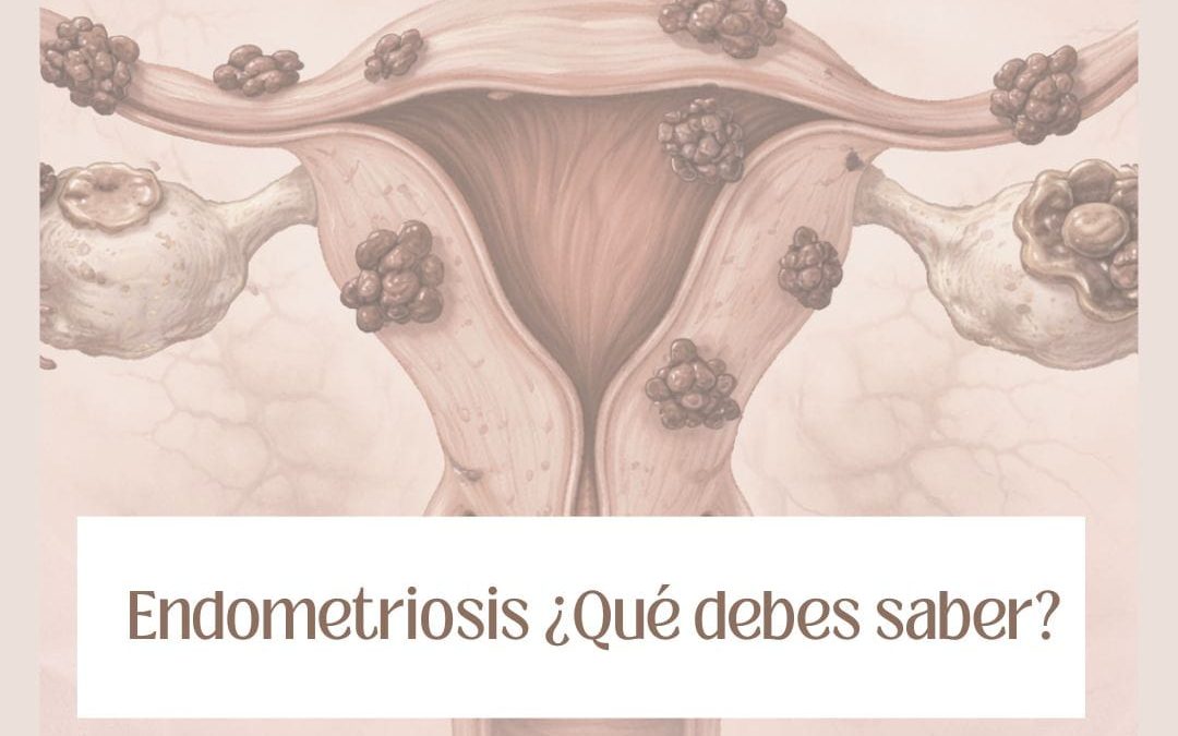 ¿Cómo se detecta la endometriosis?