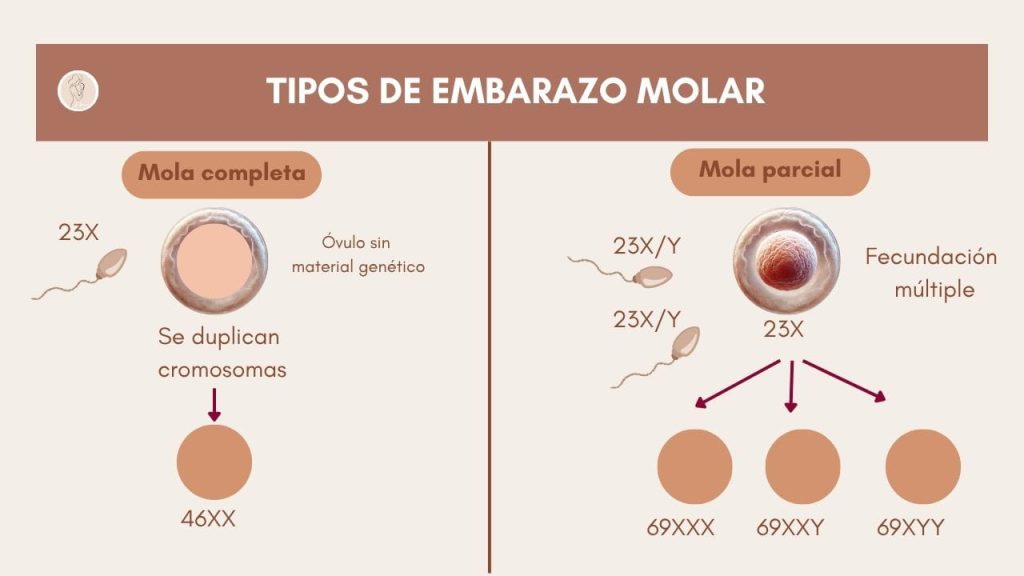 embarazo molar que es diagrama comparativo de mola completa y mola parcial, con explicación de duplicación cromosómica y fecundación múltiple