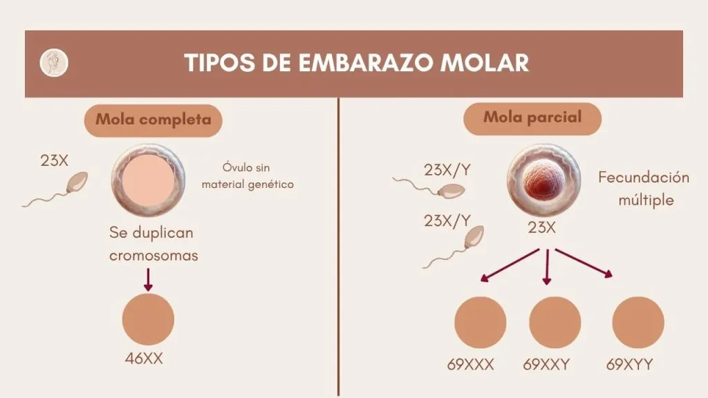 embarazo molar que es diagrama comparativo de mola completa y mola parcial, con explicación de duplicación cromosómica y fecundación múltiple
